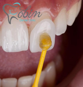 افزایش زیبایی و سلامت دندان‌ها با لمینت دندان